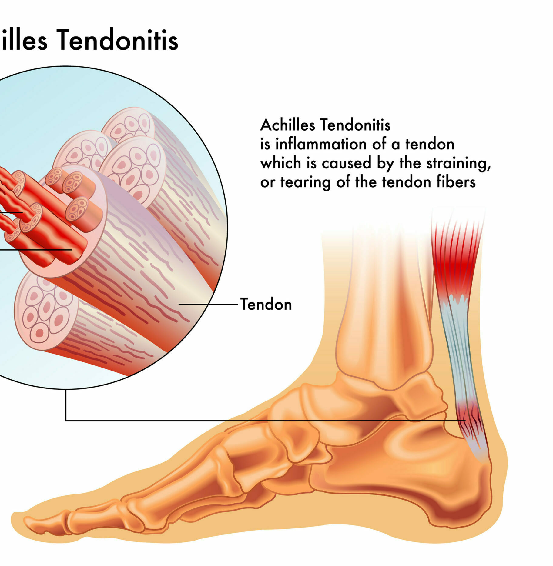 achillespees_tendinopathie