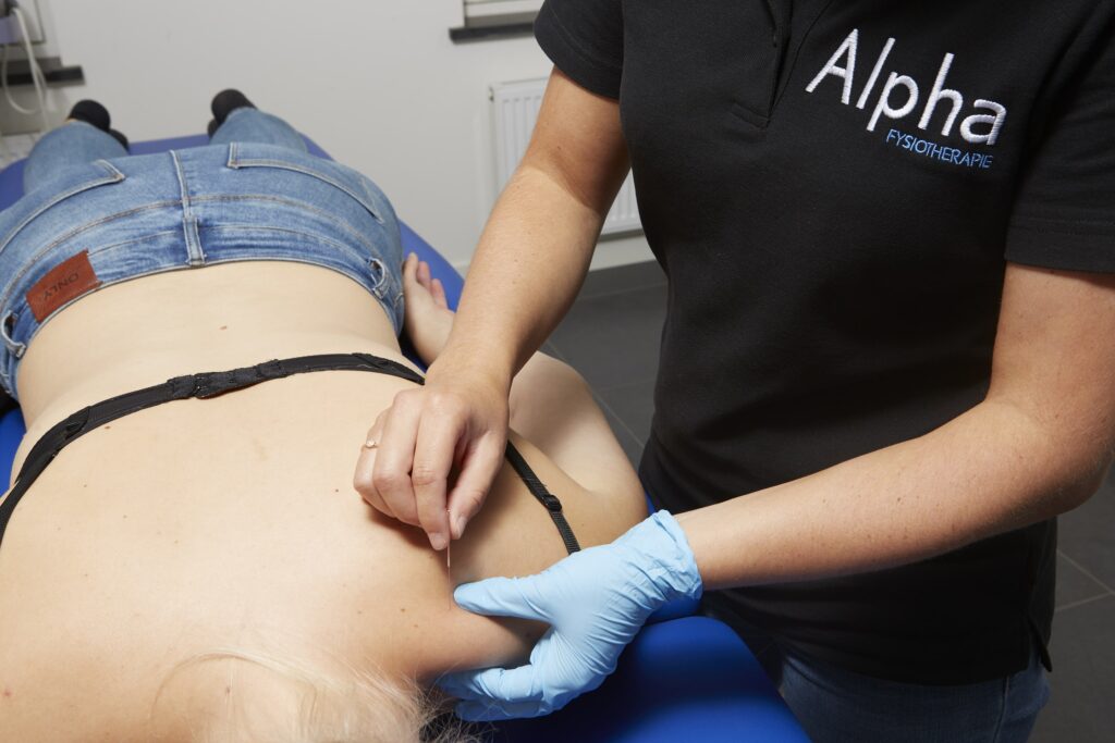 dry needling trapezius Dry_needling