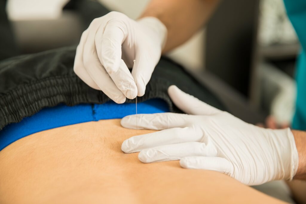 dry needling alpha utrecht dry_needling utrecht