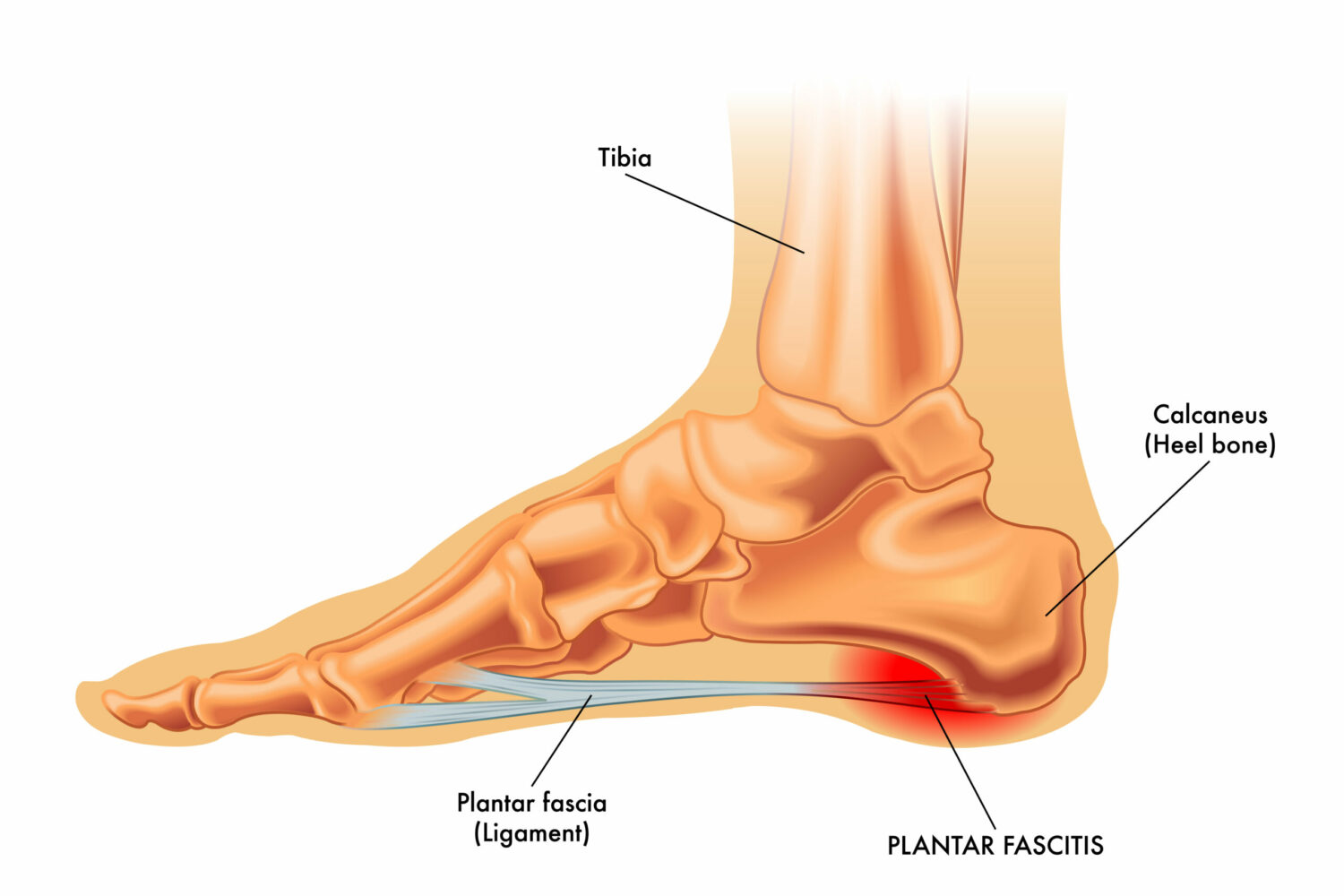 fasciitis_plantaris