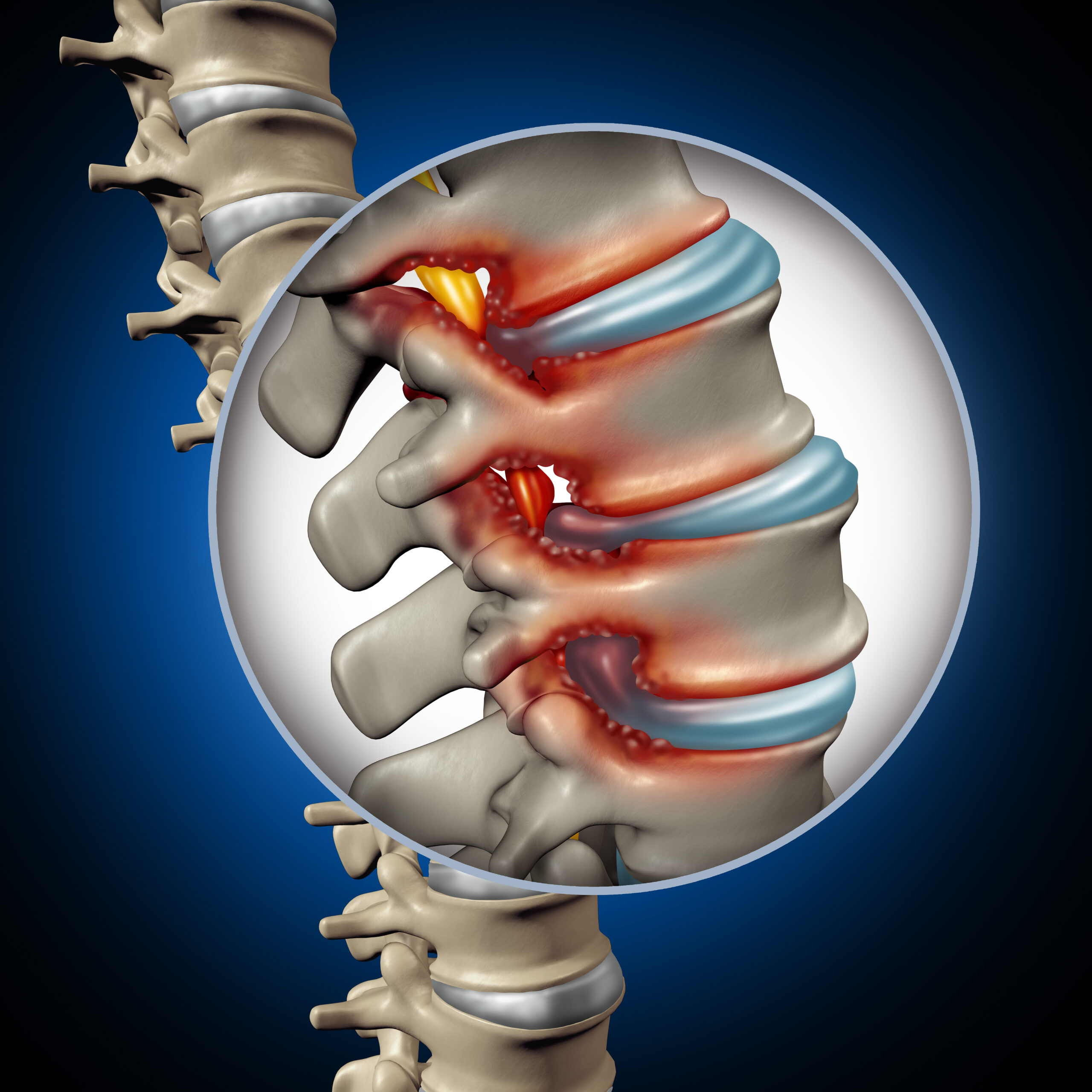 spondylose
